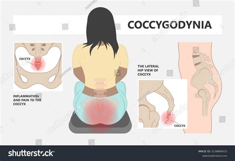 Tailbone Pain Icd 10