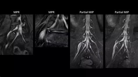 MRI nerve visualization informs surgery - Philips