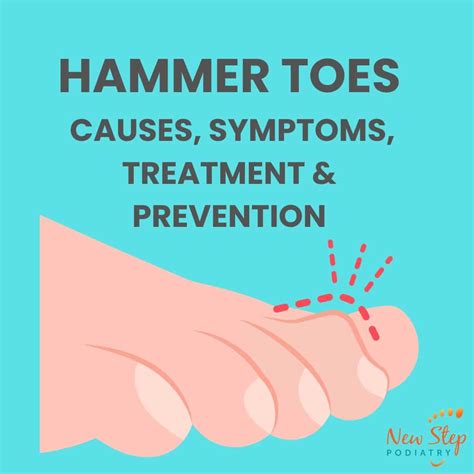Hammer Toes: Causes, Symptoms and How to Manage Them