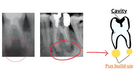 Abscess under Root Canal: Don't Ignore It!