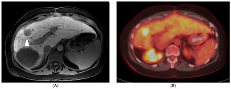Imaging Considerations before and after Liver-Directed Locoregional Treatments for Metastatic ...