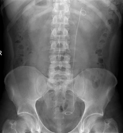 Ureteric stent - Radiology at St. Vincent's University Hospital