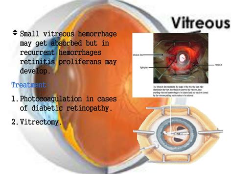 PPT - Vitreous Anatomy & Diseases: Understanding Symptoms, Causes, and Treatment Options ...