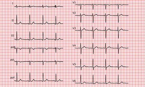 Ecg Suggests Lae Echo Reveals An Absolutely Normal