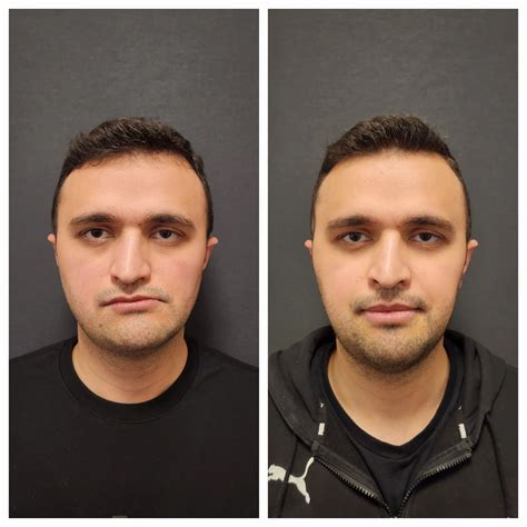 Benefits of Double Jaw Surgery (A Comprehensive Guide 2025)