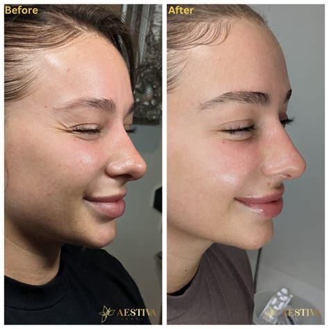 Crow's Feet Treatments - Aestiva Clinic