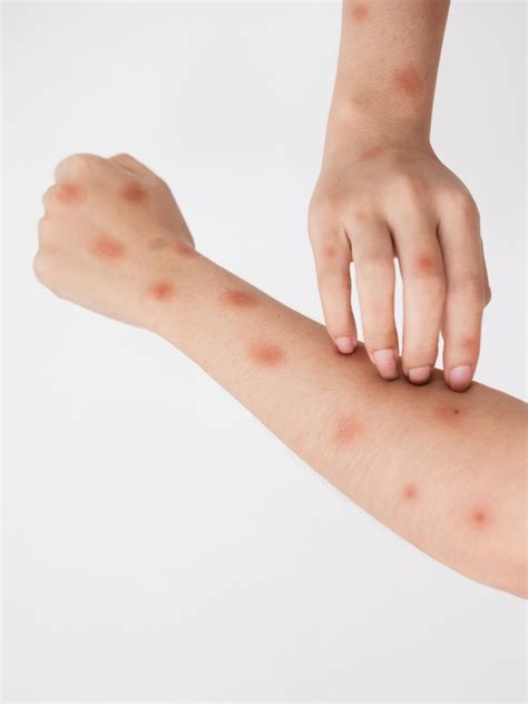 Mpox: What precautions should pregnant women take?