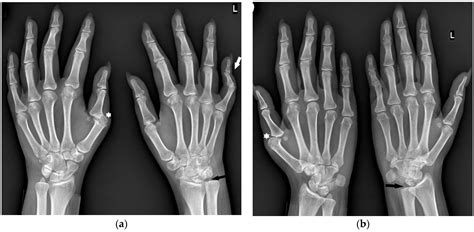 Hand and Wrist Involvement in Seropositive Rheumatoid Arthritis ...