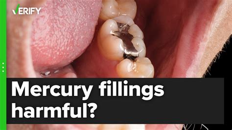 Mercury Toxicity In Dentistry