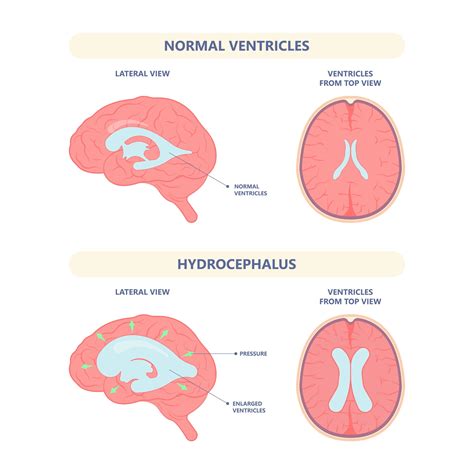 Hydrocephalus