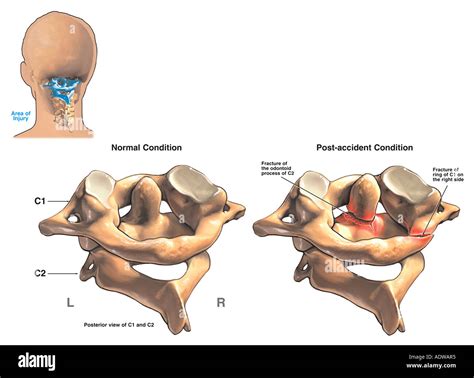 Axis And Atlas Vertebrae Labeled