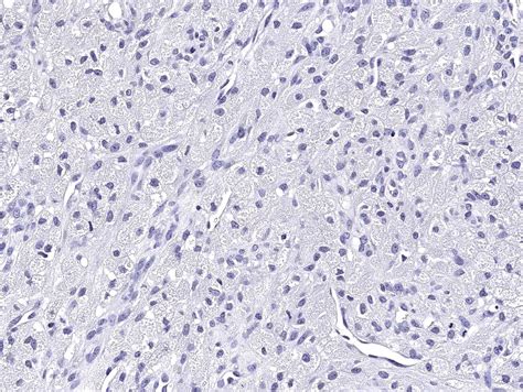 Pathology Outlines - Granular cell tumor