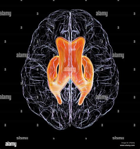 Enlarged lateral ventricles of the brain, illustration Stock Photo - Alamy