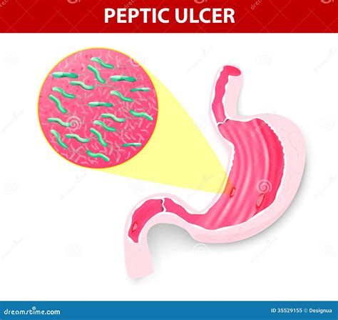 Peptic ulcer stock vector. Illustration of gastroenterologist - 35529155