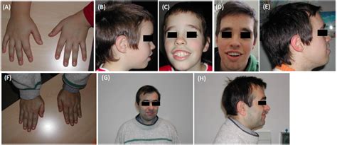 Coffin Lowry Syndrome Pedigree