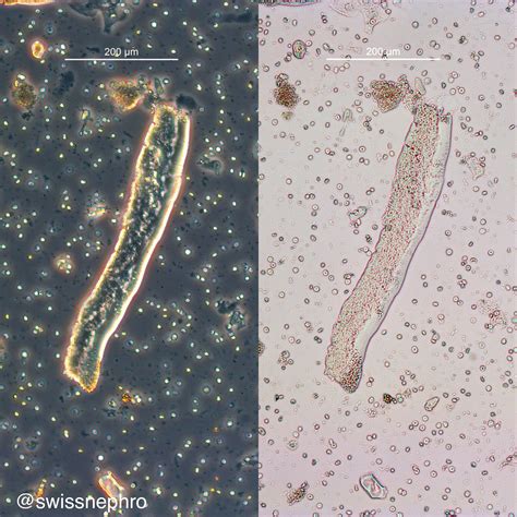 Urine Microscopy with Dr. Florian Buchkremer – GlomCon (pubs)