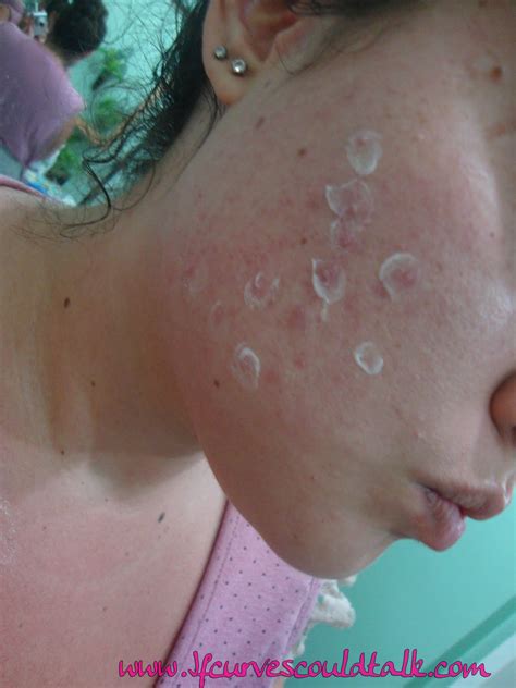 If Curves Could Talk: REVIEW: Clean & Clear Persa-Gel 10