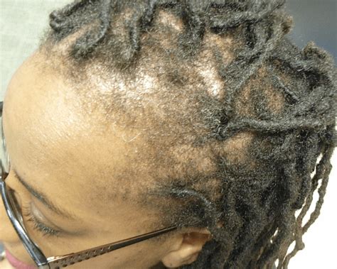 Black Hair Loss – Before/After Treatment Photos | The Hair Loss Centre