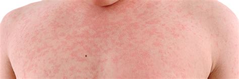 HEAT RASH TREATMENT THROUGH HOMEOPATHY