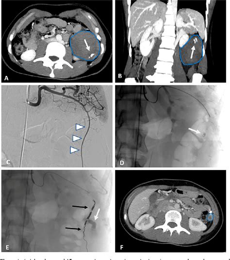 Figure 1 from Trophoblastic Tissue Reimplantation below the Spleen Following Laparoscopic ...