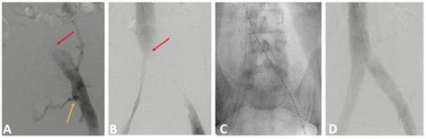 Management of Extra-Pelvic Varicose Veins of Pelvic Origin in Female ...