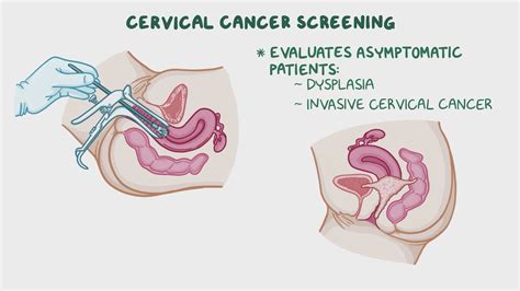 Image result for Cervical Screening Explained