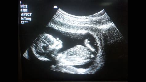 Ultrasound 的图像结果