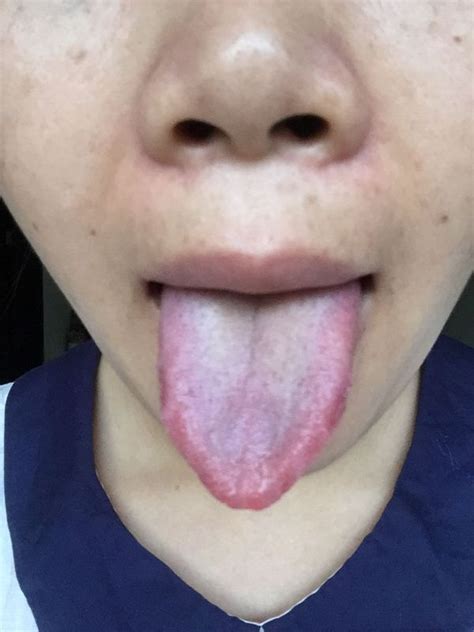 舌苔厚白红点 我舌头的舌苔很厚很白而且有很多小红点是上火了吗_第二人生