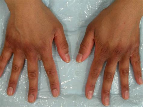 why doctor's struggle to identity eczema on darker tones Background