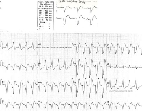 Wide Complex Tachycardia: Left Bundle Branch Block With Subsequent Rhythm Strip | ECG Guru ...