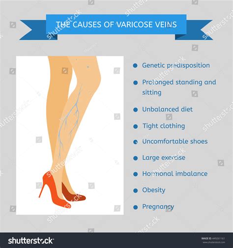 Causes Varicose Veins Infographics Female Legs Stock Vector 449261161 - Shutterstock