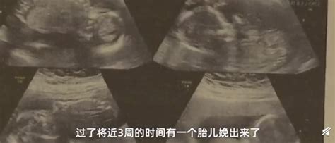 产妇怀4胞胎坚持顺产，肚子都快撑破了，医生看到婴儿时开心笑了__凤凰网