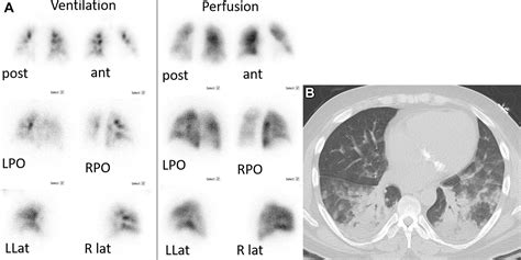 Ventilation-Perfusion Scan: A Primer for Practicing RadiologistsRadioGraphics