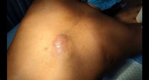 Image result for Giant Abscess Exploding On Back
