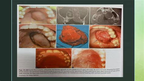 salivary glands tumors | PPTX
