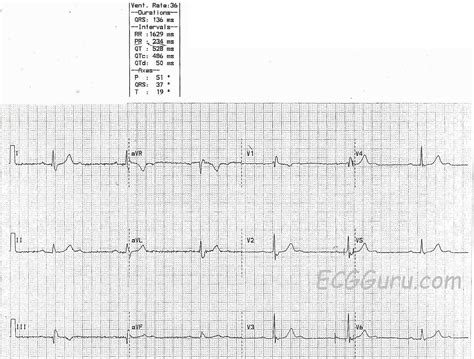 2:1 AV block | ECG Guru - Instructor Resources