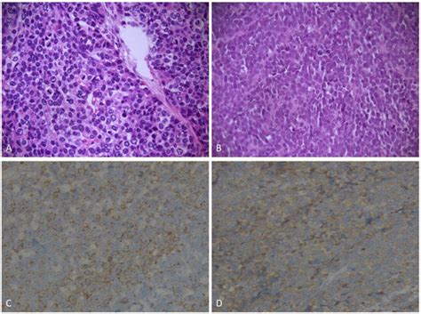 Equivalent Survival between Gastric Large-Cell Neuroendocrine Carcinoma ...