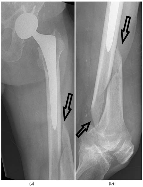 Impacted Fracture Femur