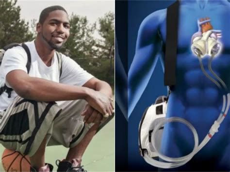 This 25 Year Old Lived Happily With His Heart In His Backpack For 1.5 Years