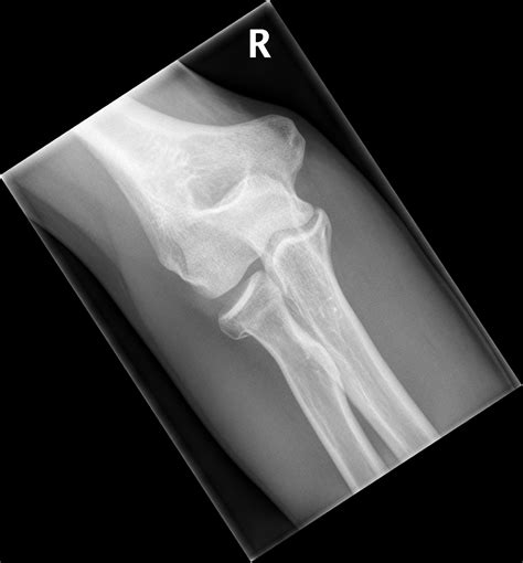 X Ray Elbow Joint Effusion at Pearl Murray blog