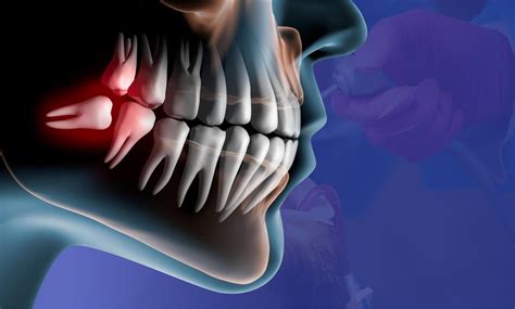Can Wisdom Tooth Regrow