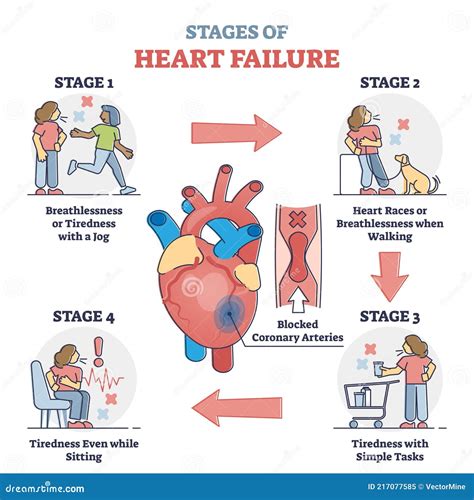 Congestive Heart Failure Stages Life Expectancy