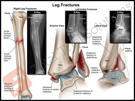 Medical Illustration | Left trimalleolar ankle fracture and right tibia ...