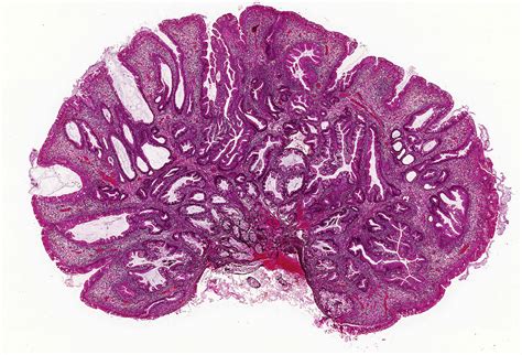 When to suspect and how to diagnose syndromic polyps and carcinomas of ...