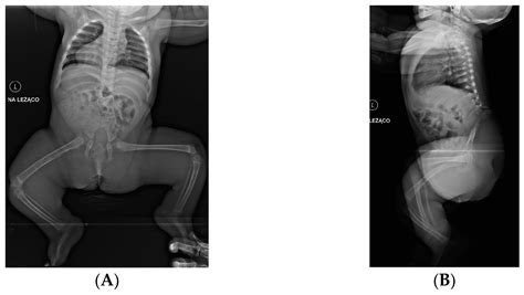 Caudal Regression Syndrome—A Narrative Review: An Orthopedic Point of View