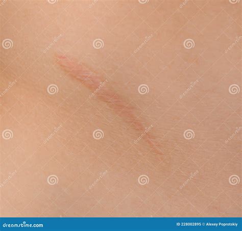 Healed Scar after Appendicitis Surgery. Stock Image - Image of appendicitis, surgery: 228002895