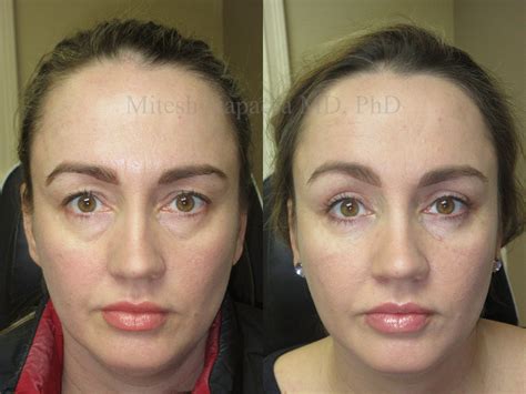 Before and six weeks after upper and lower blepharoplasty surgery | Boston Eyelid Surgery