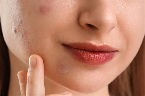 Scientists Just Discovered a Pimple Patch That May Work Better Than Most Acne Creams