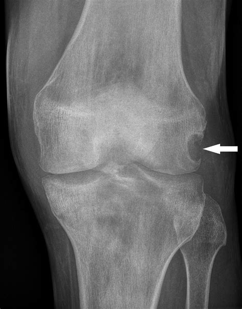 Gout Knee Xray 3D Segmentation Shows Promise In Knee MRI Exams