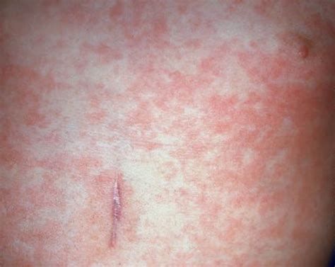 Roseola - Causes, Roseola Infantum Symptoms, Rash, Treatment
